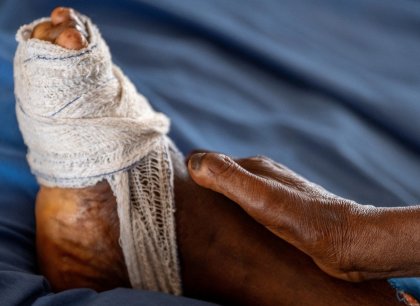 Do Evropy se vrátila lepra